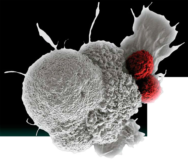 Клетки плоскоклеточного рака ротовой полости атакованы двумя цитотоксическими Т-клетками (красного цвета). Этот процесс – часть естественного иммунного ответа. © CC BY-NC 2.0 /R.E. Serda, Duncan Comprehensive Cancer Center at Baylor College of Medicine, National Cancer Institute, NIH